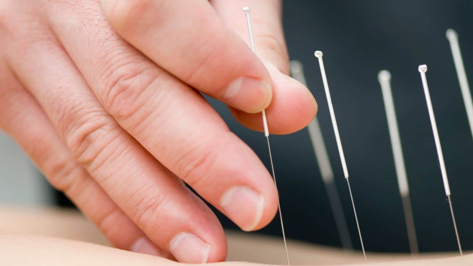 Acupuncture and IUI