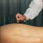 How to Manage Back Pain with Acupuncture