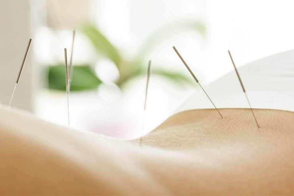 More Acupuncture Better for FET Patients